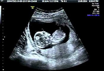 Domowa aborcja. Śmiertelne żniwo także wśród kobiet!
